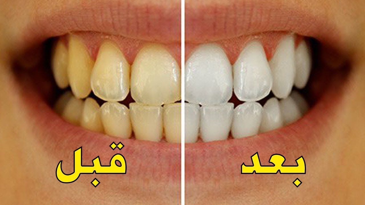 تمتعي بأسنان بيضاء كالثلج بمكون منزلي هيزيل الأصفرار والجير من الأسنان في دقائق