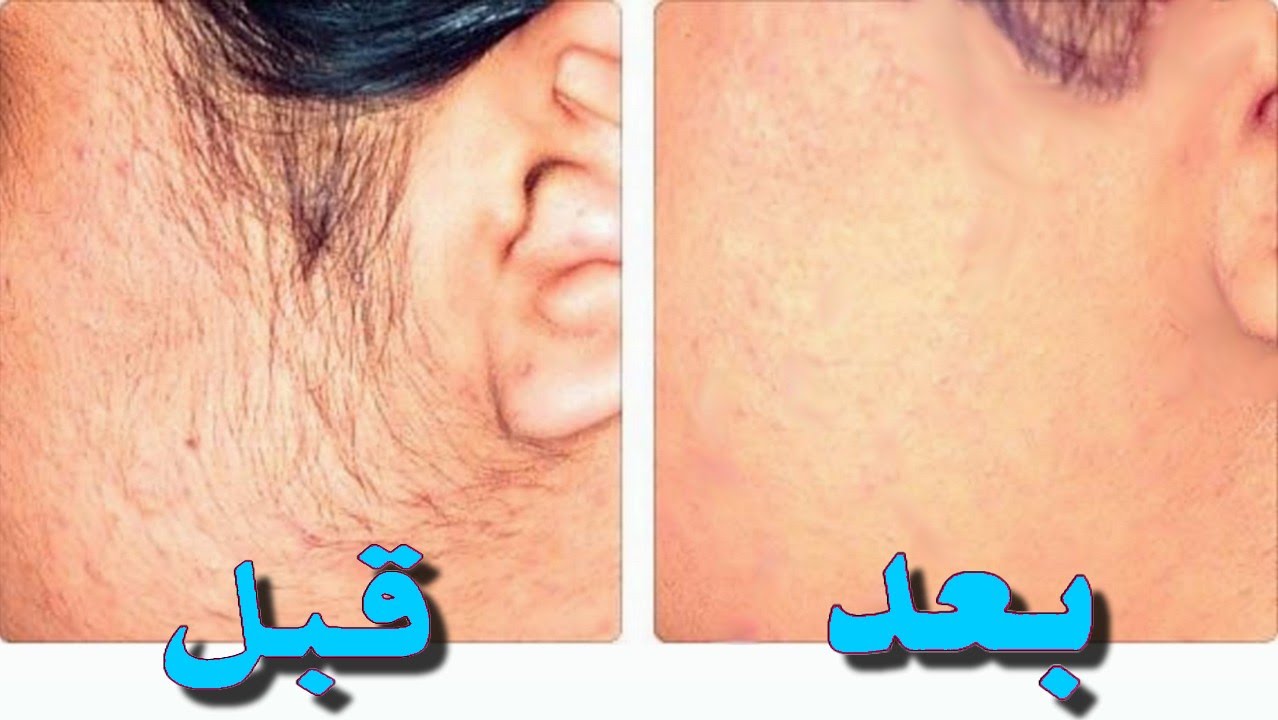 اقوى وصفة يابانية لإزالة الشعر الزائد من الجذور وبدون الم في دقائق معدودة ولم يعود مجدداً 