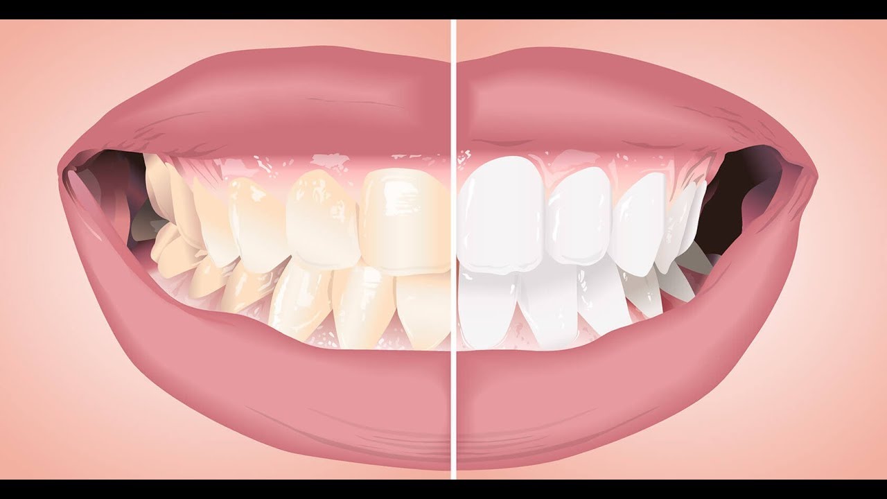 طرق تبيض الأسنان المنزلية وجعلها بيضاء مثل أسنان الأطفال