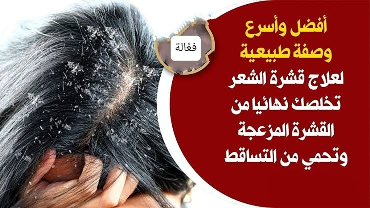 “اتخلصي من قشرة الشعر بـ 2 جنيه” طريقة فعالة ومجربة للتخلص من قشرة الشعر نهائياً وبلا عودة!